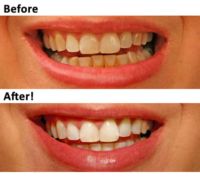 teeth whitening will come to your home or office and whiten your teeth 